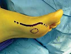 آلية حدوث إصابة إصبع القدم العشبي