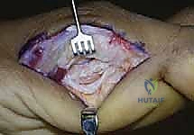 التخطيط الجراحي لإصابة Turf Toe