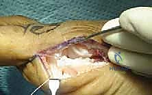 التعامل الجراحي مع العظام السمسمانية