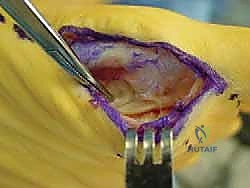 صورة توضيحية لـ إصابة إصبع القدم العشبي (Turf Toe): دليل شامل للتشخيص والعلاج الجراحي مع الأستاذ الدكتور محمد هطيف