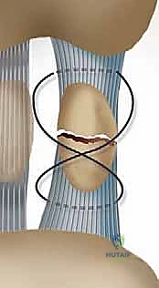 صورة توضيحية لـ إصابة إصبع القدم العشبي (Turf Toe): دليل شامل للتشخيص والعلاج الجراحي مع الأستاذ الدكتور محمد هطيف