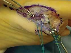 صورة طبية: إصابة إصبع القدم العشبي (Turf Toe): دليل شامل للتشخيص والعلاج الجراحي مع الأستاذ الدكتور محمد هطيف