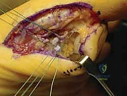 صورة توضيحية لـ إصابة إصبع القدم العشبي (Turf Toe): دليل شامل للتشخيص والعلاج الجراحي مع الأستاذ الدكتور محمد هطيف