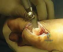 صورة توضيحية لـ إصابة إصبع القدم العشبي (Turf Toe): دليل شامل للتشخيص والعلاج الجراحي مع الأستاذ الدكتور محمد هطيف