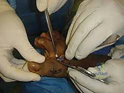 صورة توضيحية لـ إصابة إصبع القدم العشبي (Turf Toe): دليل شامل للتشخيص والعلاج الجراحي مع الأستاذ الدكتور محمد هطيف