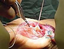 صورة طبية: إصابة إصبع القدم العشبي (Turf Toe): دليل شامل للتشخيص والعلاج الجراحي مع الأستاذ الدكتور محمد هطيف