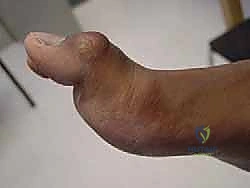 Illustration of hallux mp joint - Dr. Mohammed Hutaif