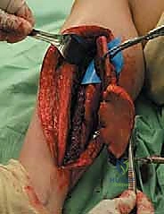 استخراج الطعم العظمي من الشظية بدقة عالية