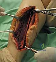 متابعة التئام الجروح في الأسابيع الأولى