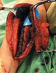 تثبيت العظم بالأشعة أثناء العملية لضمان الاستقامة