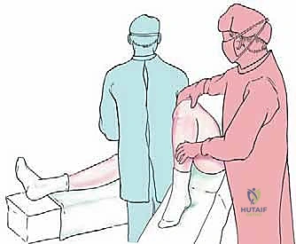 صورة شعاعية تظهر التحام العظم وتضخمه لتعويض الفجوة