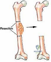 متابعة التئام العظم المنقول بالأشعة السينية