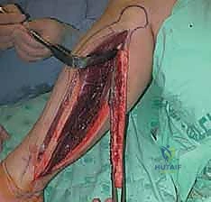 التدفق الدموي الناجح بعد التوصيل المجهري