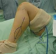 صورة طبية: ترقيع الشظية الوعائي الحر: إتقان إعادة بناء العظام الطويلة المعقدة في صنعاء مع الأستاذ الدكتور محمد هطيف