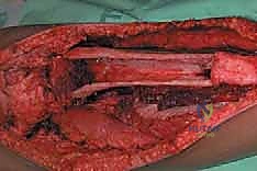 صورة توضيحية لـ ترقيع الشظية الوعائي الحر: إتقان إعادة بناء العظام الطويلة المعقدة في صنعاء مع الأستاذ الدكتور محمد هطيف