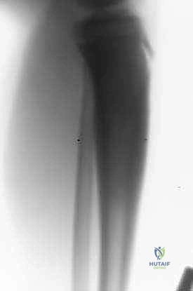 صورة توضيحية لـ ترقيع الشظية الوعائي الحر: إتقان إعادة بناء العظام الطويلة المعقدة في صنعاء مع الأستاذ الدكتور محمد هطيف