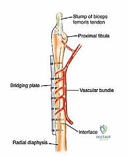 صورة توضيحية لـ ترقيع الشظية الوعائي الحر: إتقان إعادة بناء العظام الطويلة المعقدة في صنعاء مع الأستاذ الدكتور محمد هطيف