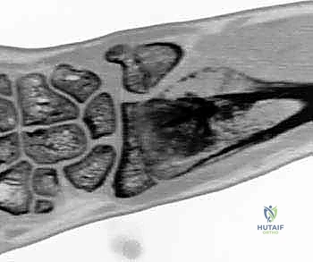 Illustration of free vascularized fibular - Dr. Mohammed Hutaif