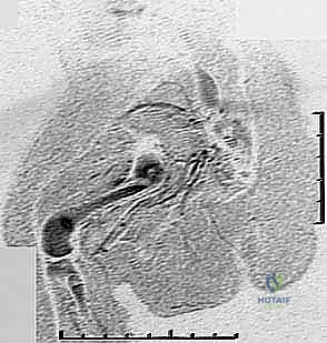 مقارنة بين الطرف السليم والطرف المصاب بنقص الفخذ