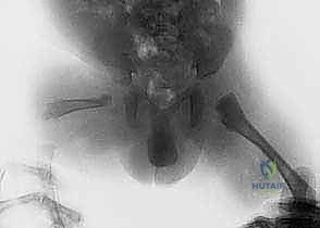 تصوير شعاعي يوضح غياب الاتصال بين رأس الفخذ وجسم العظمة