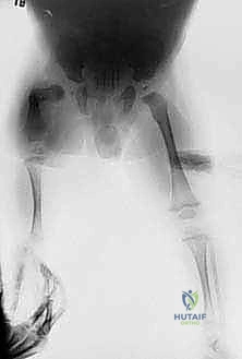 صورة إشعاعية تظهر التباين في طول عظام الفخذ