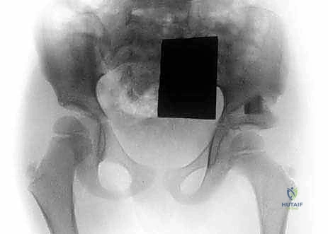 الدكتور هطيف أثناء دراسة صور الأشعة المعقدة