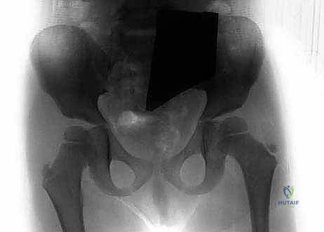 أشعة تظهر حالة متقدمة من الفخذ الأفحج