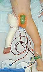 تثبيت الحوض وتغطية رأس الفخذ بشكل كامل