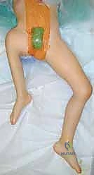 أشعة توضح التئام العظم بعد عملية السوبر هيب بفترة