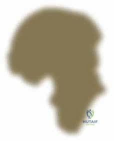 صورة توضيحية لـ دليلك الشامل لعلاج نقص عظم الفخذ الخلقي: خبرة الأستاذ الدكتور محمد هطيف في صنعاء