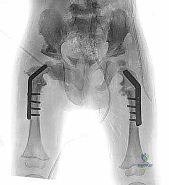 تخطيط زوايا القطع العظمي لإصلاح الفخذ الأفحج