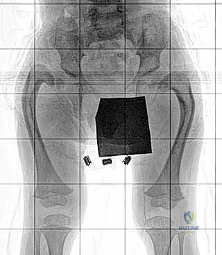 استخدام التقنيات الحديثة في التثبيت الخارجي