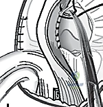 صورة توضيحية لـ دليلك الشامل لعلاج نقص عظم الفخذ الخلقي: خبرة الأستاذ الدكتور محمد هطيف في صنعاء