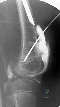 أشعة جانبية لمفصل الركبة أثناء فترة التطويل