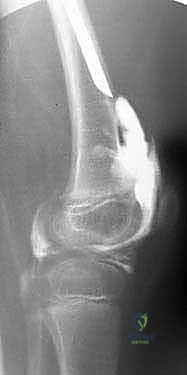 أشعة بعد تثبيت الشريحة وتعديل الزاوية