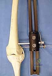 صورة توضيحية لـ دليلك الشامل لعلاج نقص عظم الفخذ الخلقي: خبرة الأستاذ الدكتور محمد هطيف في صنعاء