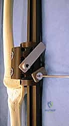 صورة توضيحية لـ دليلك الشامل لعلاج نقص عظم الفخذ الخلقي: خبرة الأستاذ الدكتور محمد هطيف في صنعاء