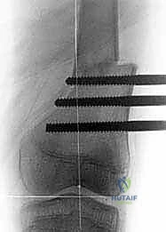 صورة توضيحية لـ دليلك الشامل لعلاج نقص عظم الفخذ الخلقي: خبرة الأستاذ الدكتور محمد هطيف في صنعاء