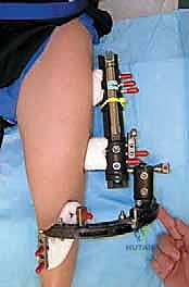 النتيجة الإشعاعية بعد استقرار مفصل الورك