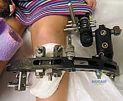 مرحلة إزالة التثبيت الخارجي وبدء المشي المستقل