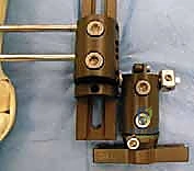 تخطيط زوايا العظام قبل الجراحة