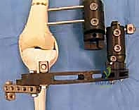 صورة توضح الفرق في الطول قبل بدء العلاج التحفظي أو الجراحي