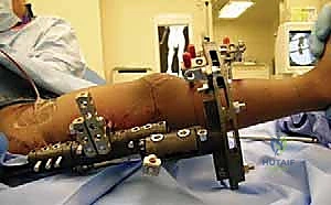 صورة طبية: دليلك الشامل لعلاج نقص عظم الفخذ الخلقي: خبرة الأستاذ الدكتور محمد هطيف في صنعاء