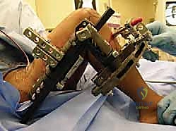 صورة توضح بناء العظم الجديد (Regenerate bone) في الفجوة