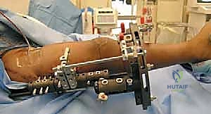 جلسة علاج طبيعي لتحسين المدى الحركي للركبة