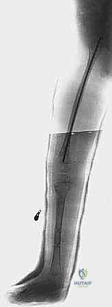 تقييم وظيفة الطرف بعد إزالة الأجهزة المساعدة