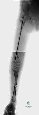 متابعة التئام العظم الجديد بالأشعة السينية