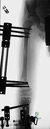 متابعة التئام الجروح وتطور الحالة العضلية