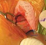 قطع وتر المقربة الطويلة: حل فعال ودائم لألم الفخذ المزمن مع الأستاذ الدكتور محمد هطيف