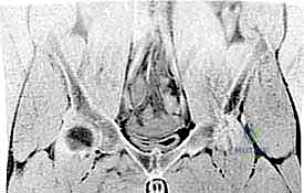 صورة توضيحية لـ قطع وتر المقربة الطويلة: حل فعال ودائم لألم الفخذ المزمن مع الأستاذ الدكتور محمد هطيف